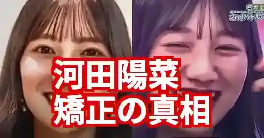 【卒業】河田陽菜の矯正は失敗？昔と今の顔の変化を画像比較